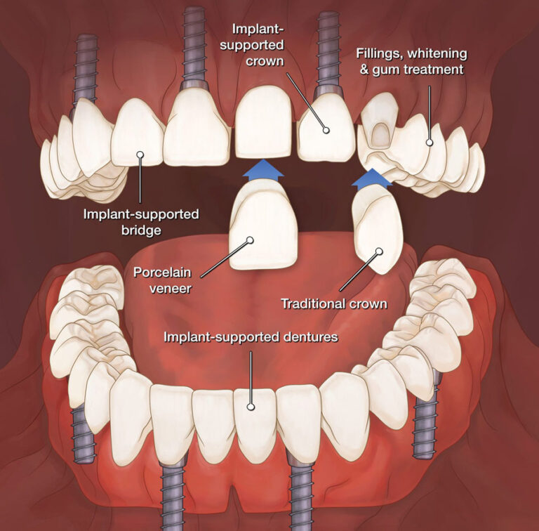 full mouth reconstruction