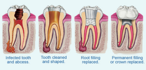 root canal