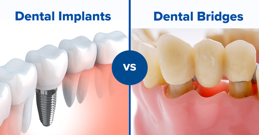 dental bridges in indore