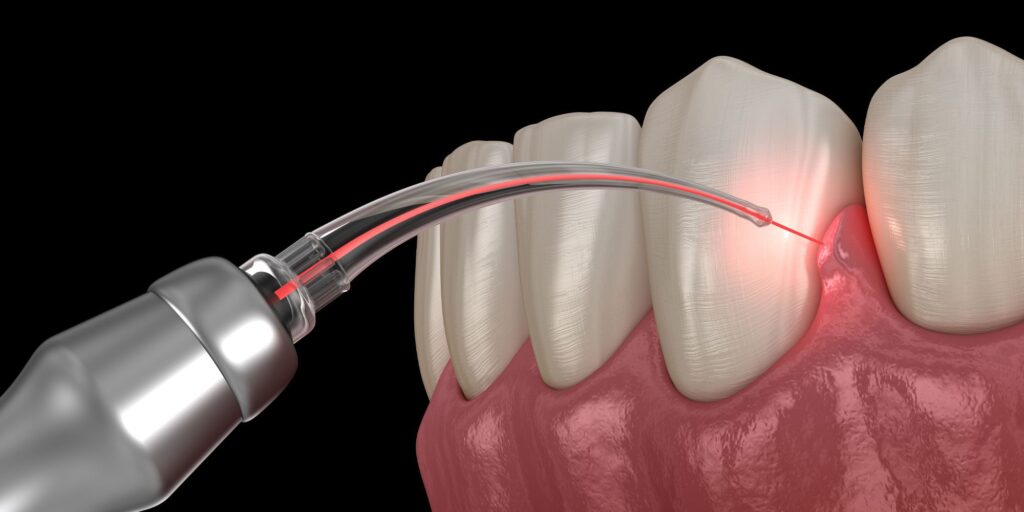 dental laser treatment