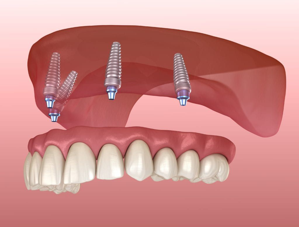 full arch dental implants